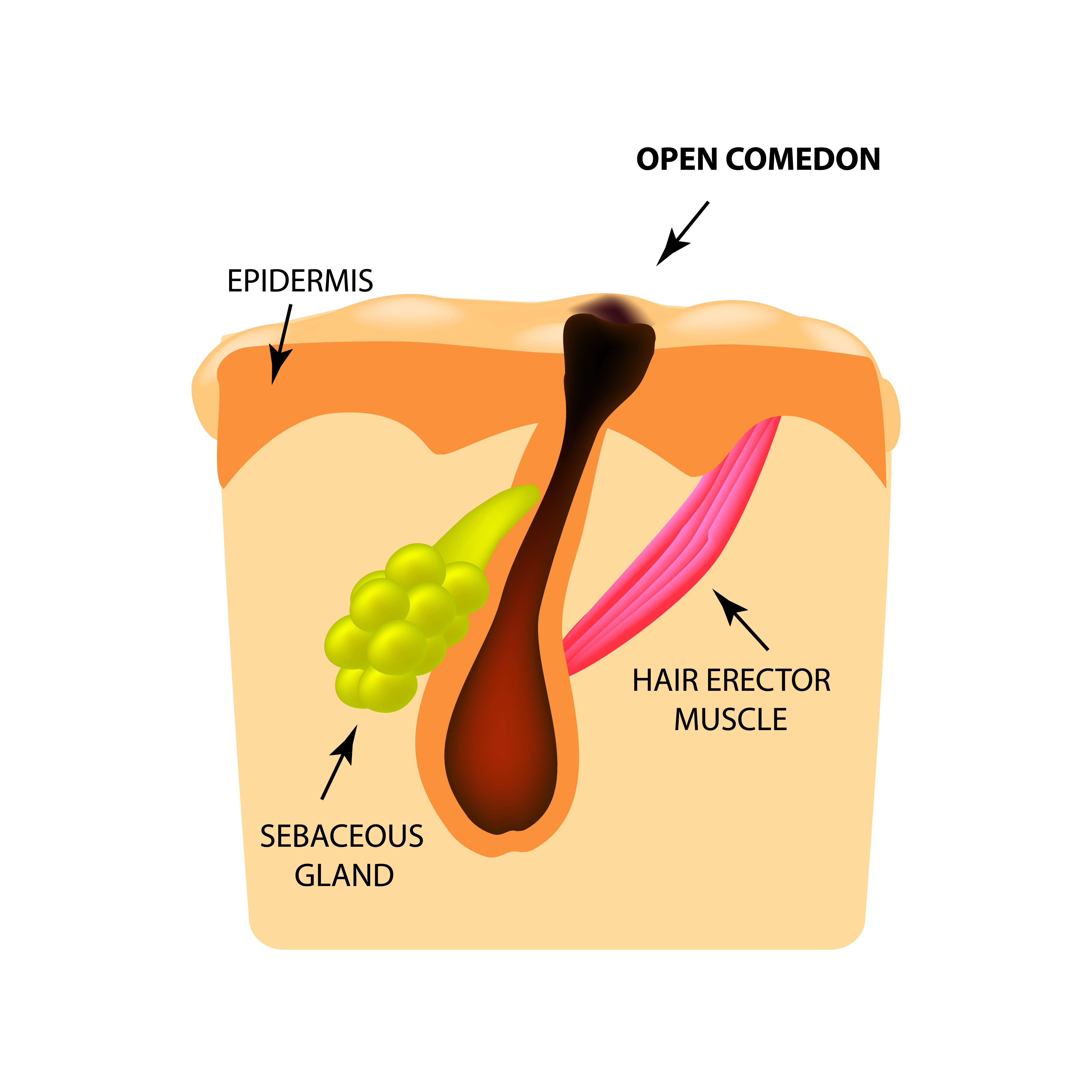 Acne types - acne-solutions